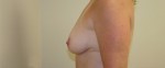 Breast Augmentation