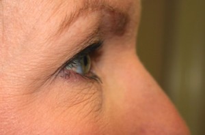 Eyelid Surgery