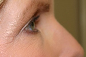 Eyelid Surgery