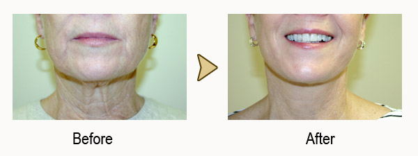 Facelift Results Richmond